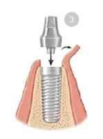 Centers For Dental Implants - Hallandale FL image 2